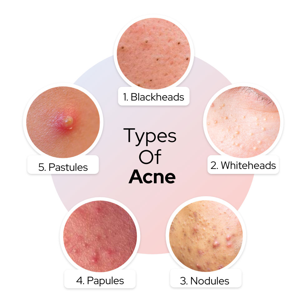 Knowing your acne type can help you cure it. Papules, Pustules, Nodulo  Cystic, Whiteheads, Blackheads, Comedogenic What is acne? And how to get  rid of it? When your hair follicles become clogged with oil or dead skin  cells, it leads to acne. Acne can get ...