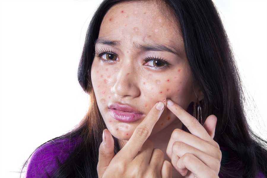 Why do people have Pimple problems in Goalpara?