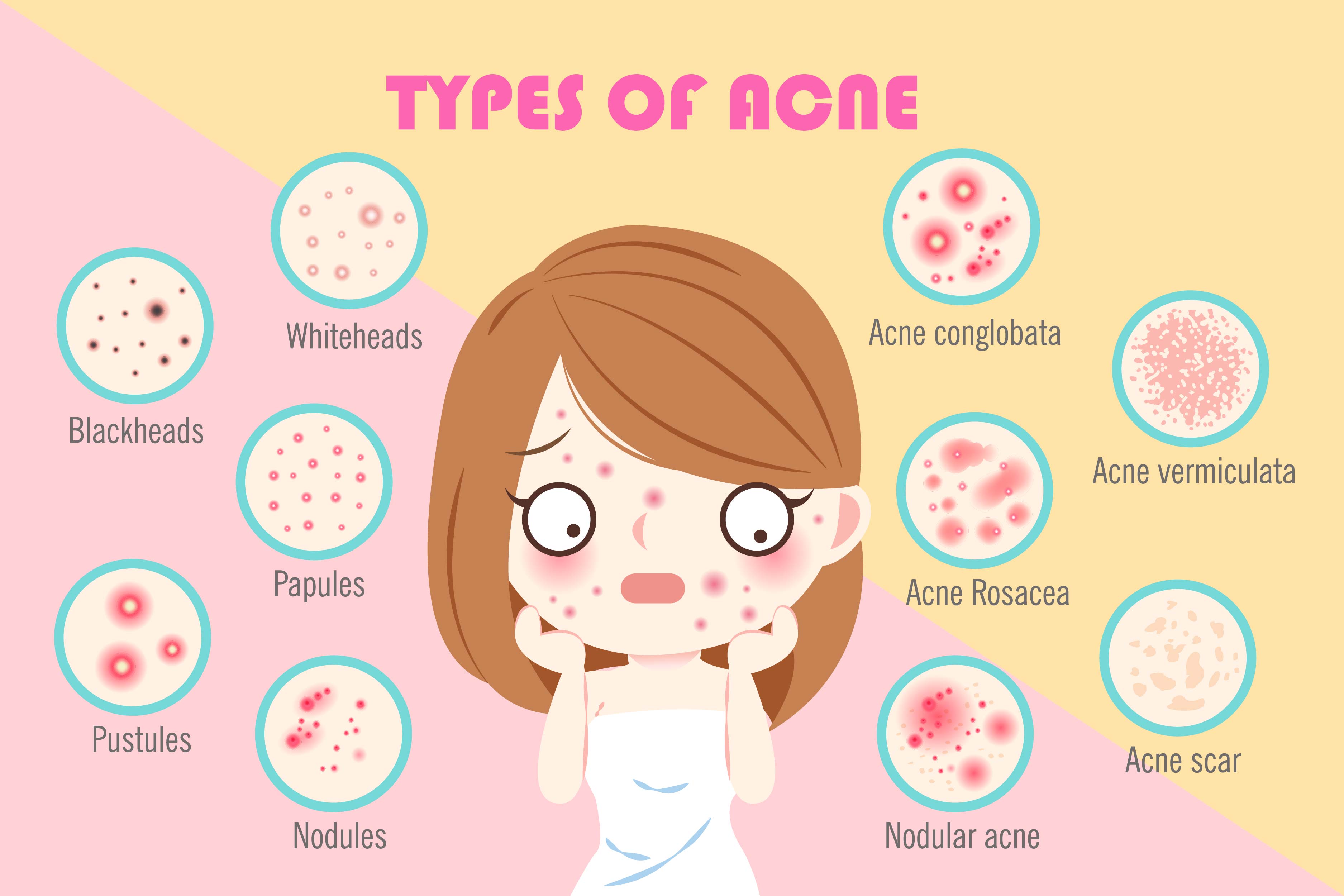 Comedones on the face are seen most frequently in the center of the face and in the T-zone 