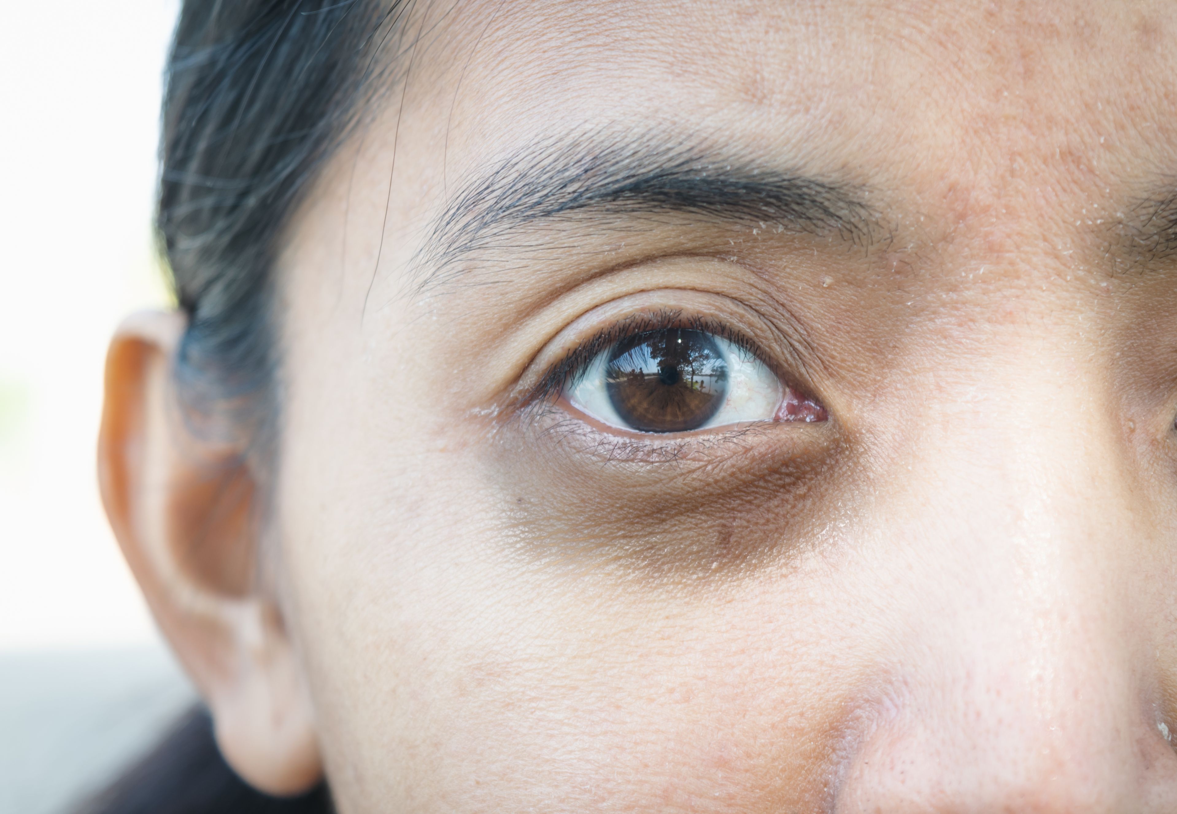 image of a girl highlighting Dark Circles