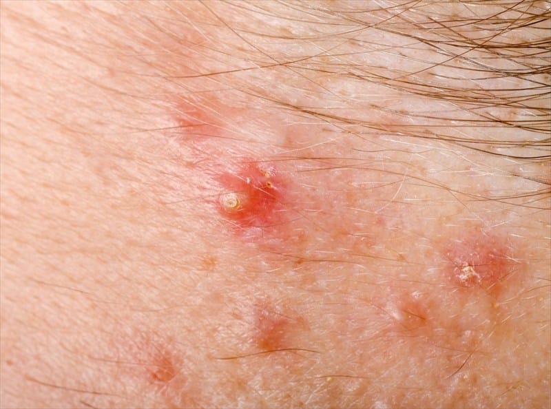 Red Bumps With White Pus On Legs