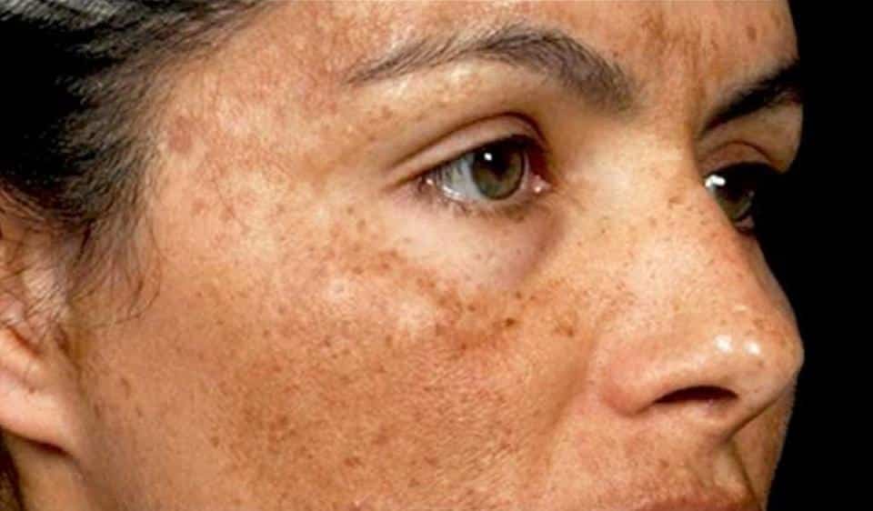 what casues hyperpigmentation