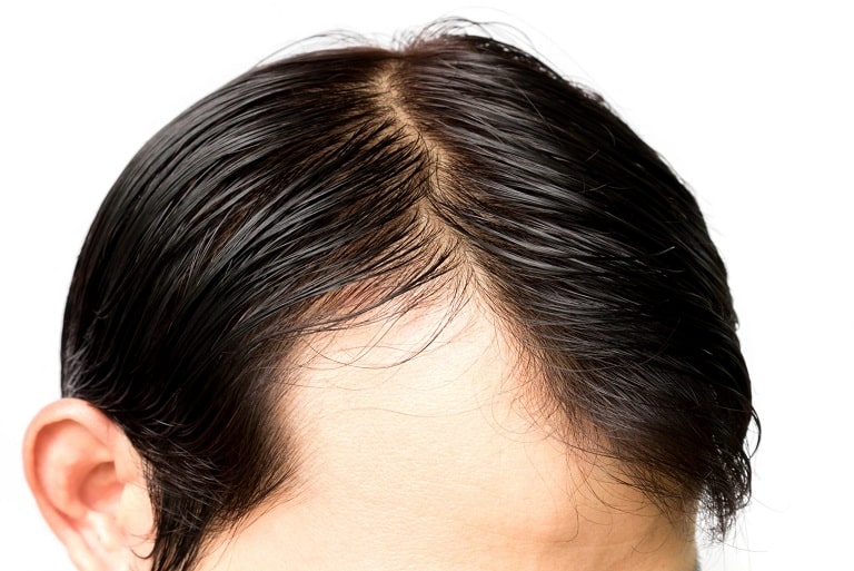 receding hairline