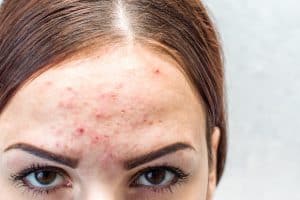 pimples on forehead