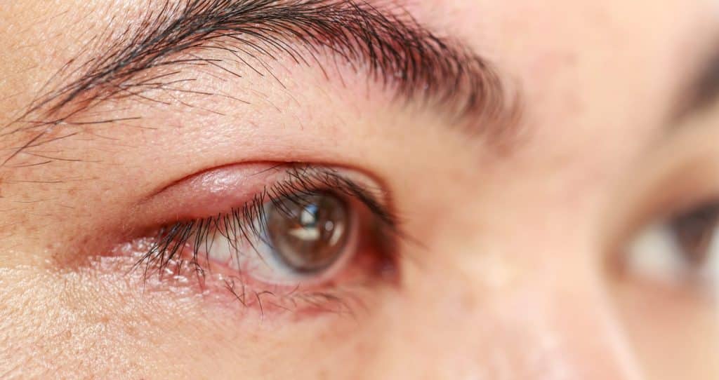 eye stye causes and treatments