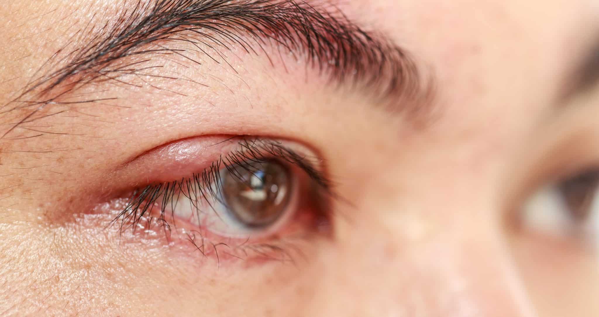 how-to-get-rid-of-a-stye-in-2-hours-101beautytips-eye-stye