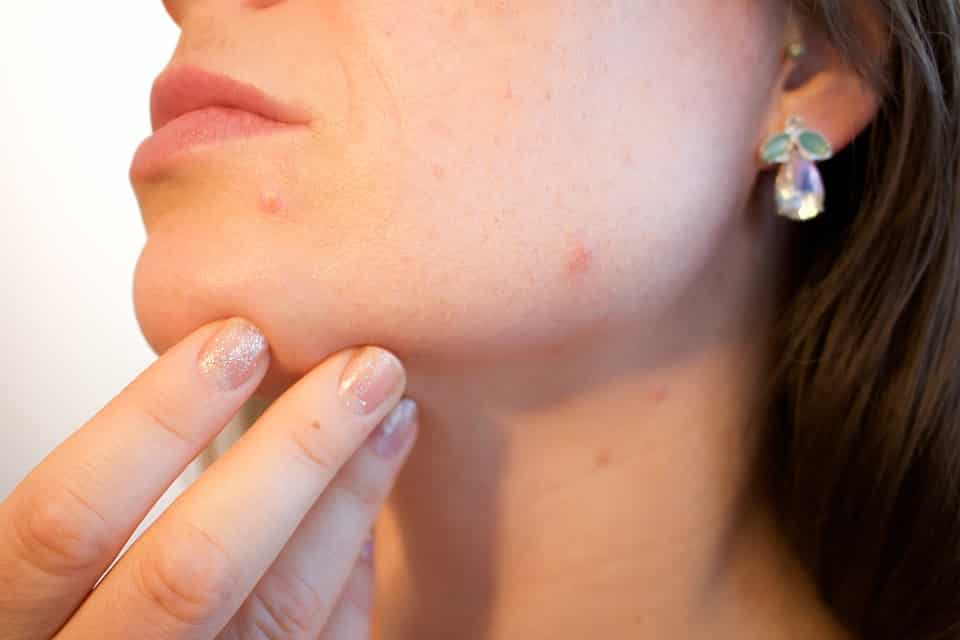 acne conglobata