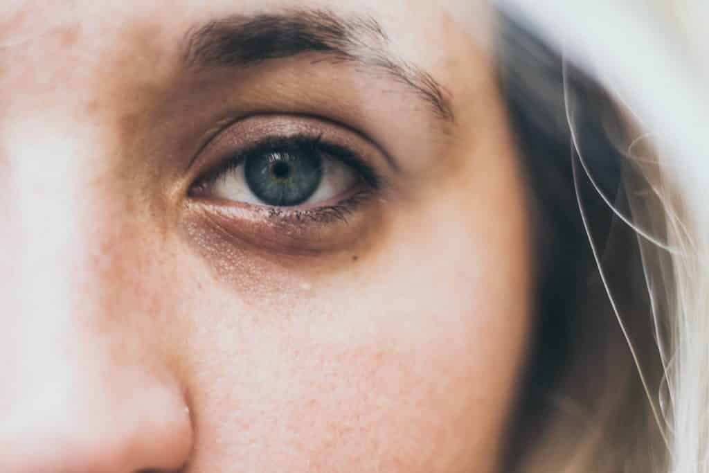 Under Eye Dark Circles: Why they don't go away easily