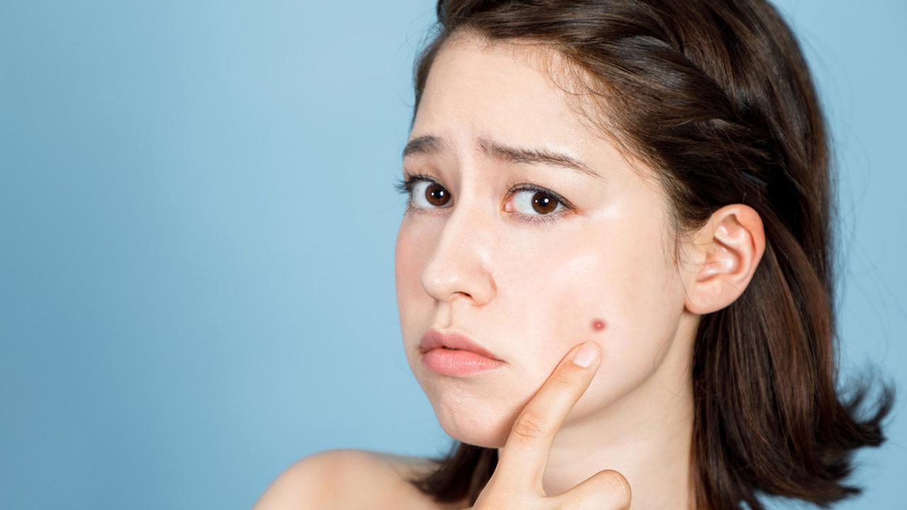 How to reduce redness from Pimples? 