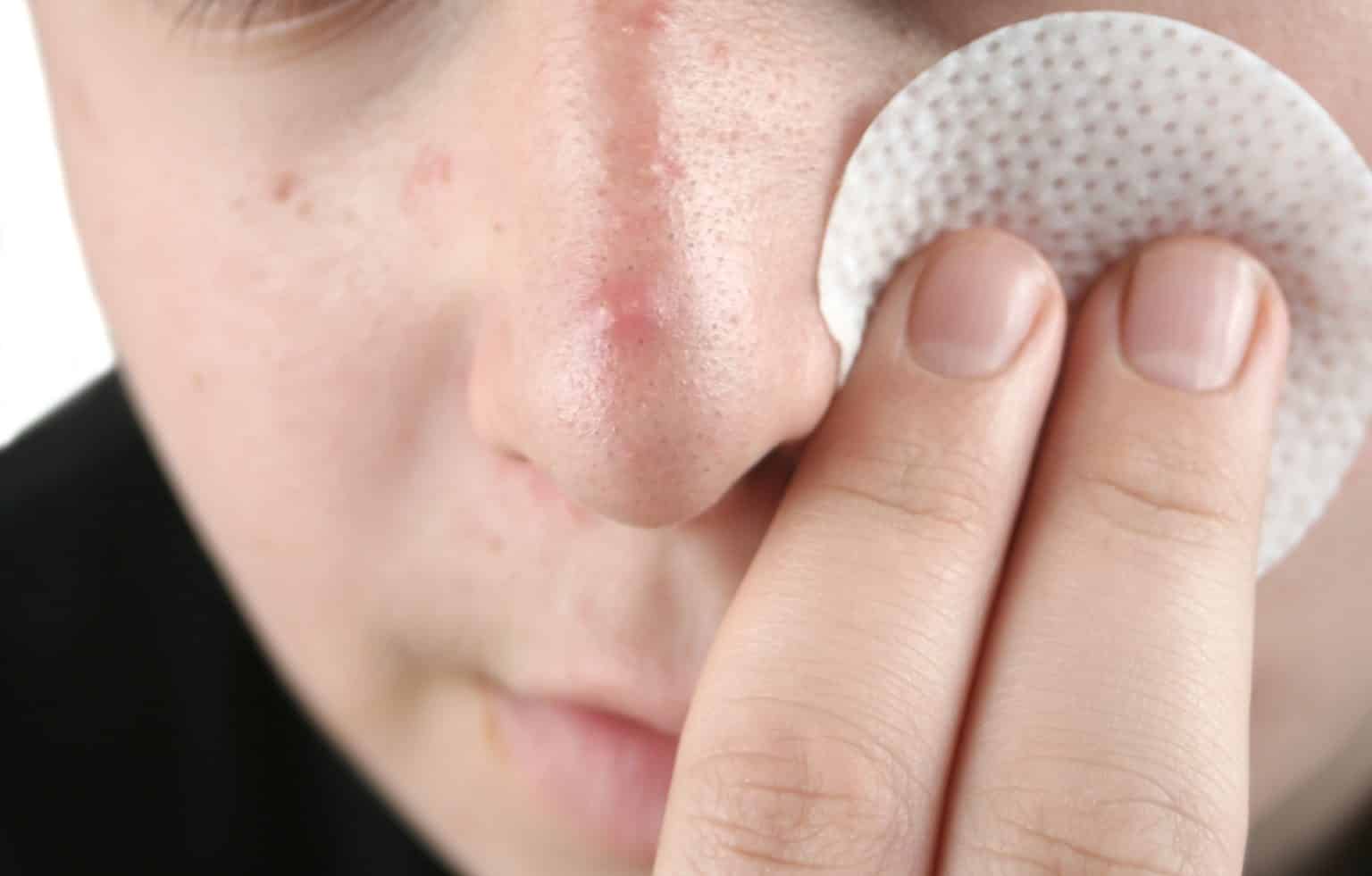 homemade-face-mask-dr-pimple-popper-reveals-the-type-of-acne-you