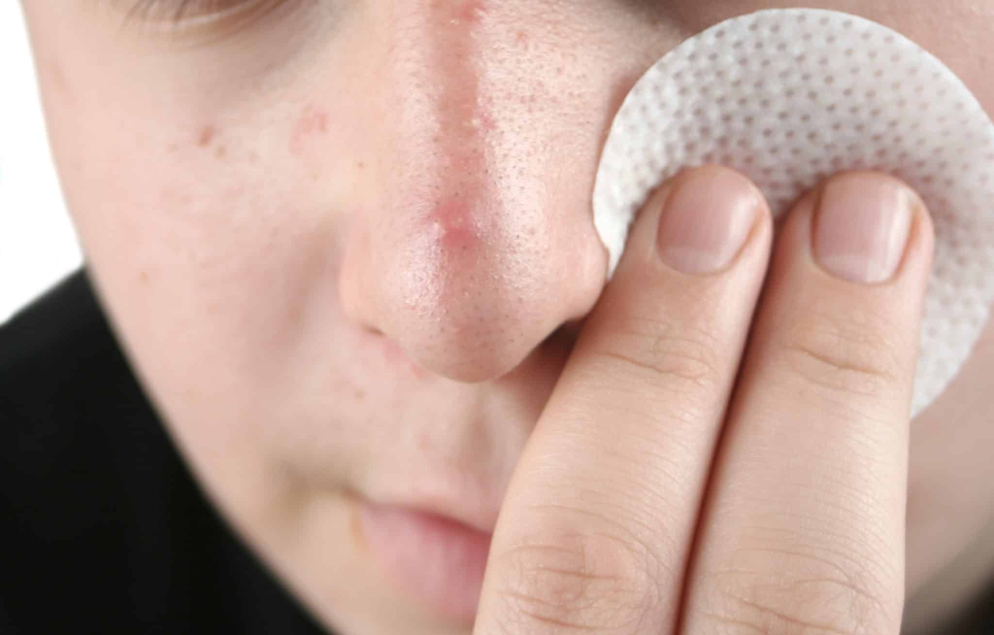 How To Get Rid Of A Blind Pimple On Your Nose