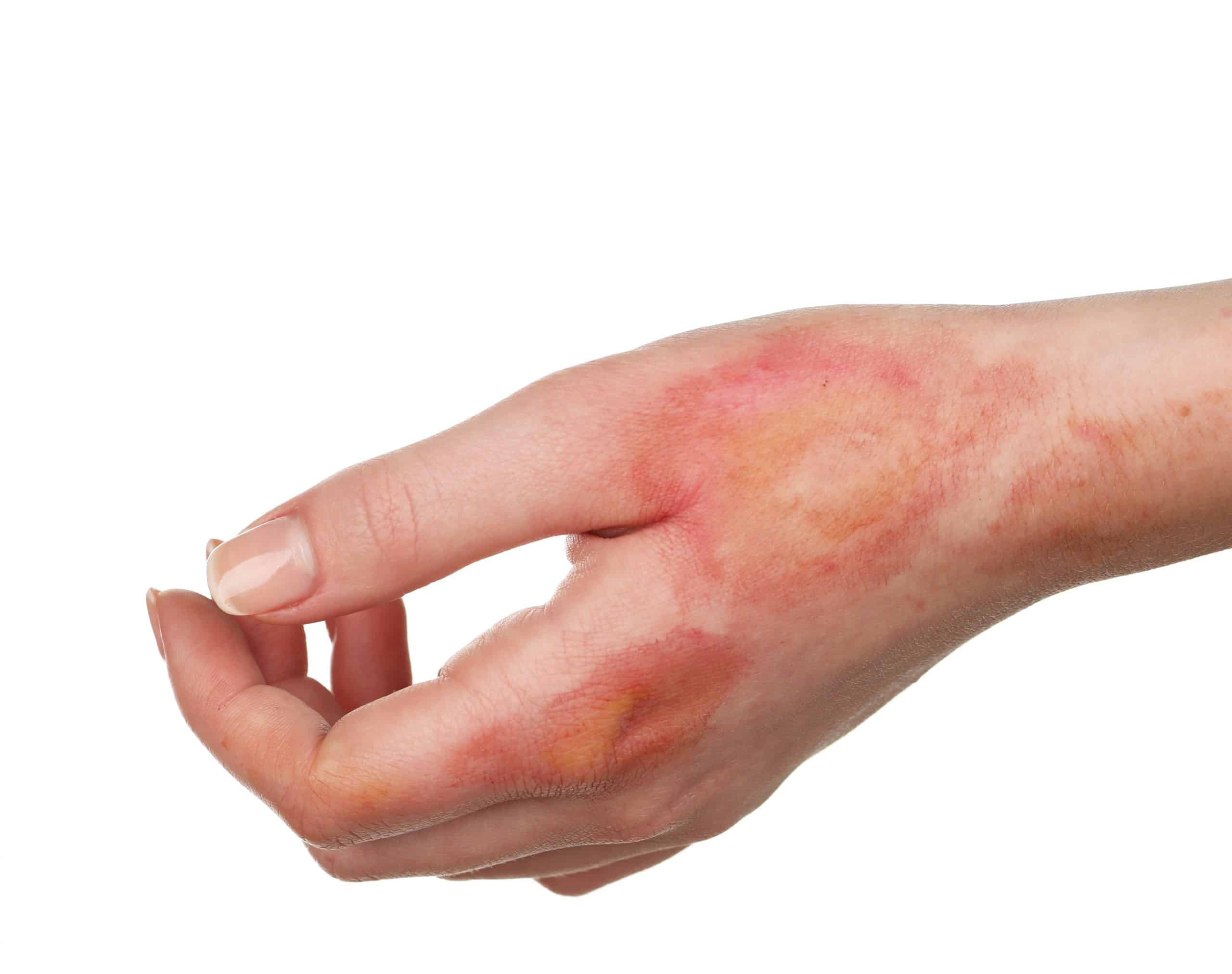 Steam Burns: Symptoms, Treatment, and Prevention