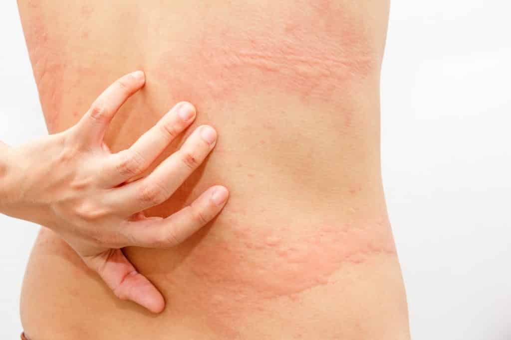 How to Identify a Skin Rash