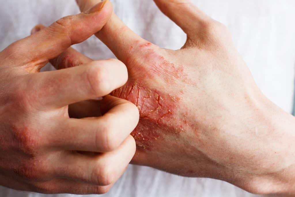 Skin Rash: Types, Symptoms, Treatment, Prevention - Cureskin