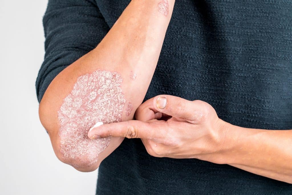 Skin Rash, Skin Rash Causes, Skin Rash Types, Skin Rash Reasons, Medicine for skin rash, Medicine for skin rash and itching, skin rash images, skin rash on face, skin rash remedies.