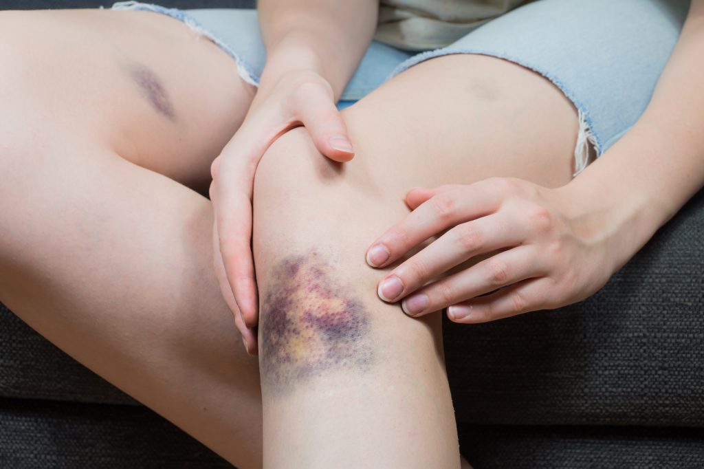 What is a contusion (bruise)? Bones, muscles, and more