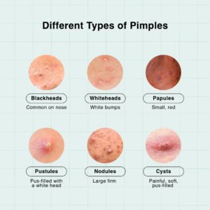 Pimples on forehead: What are the Causes & Treatments?