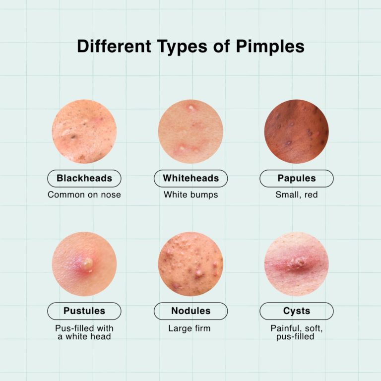 Pimples On Forehead What Are The Causes Treatments 