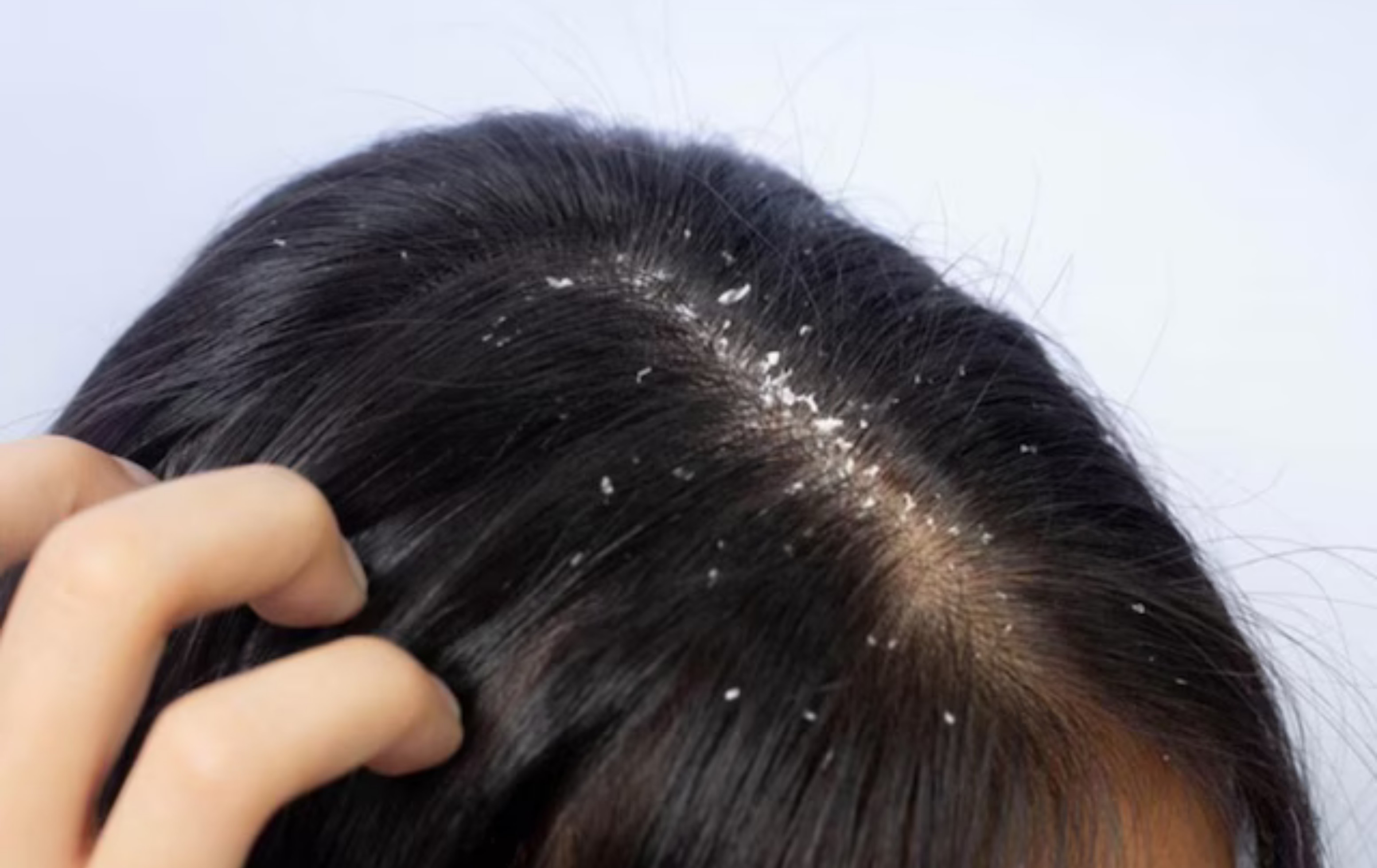 Can dandruff cause acne