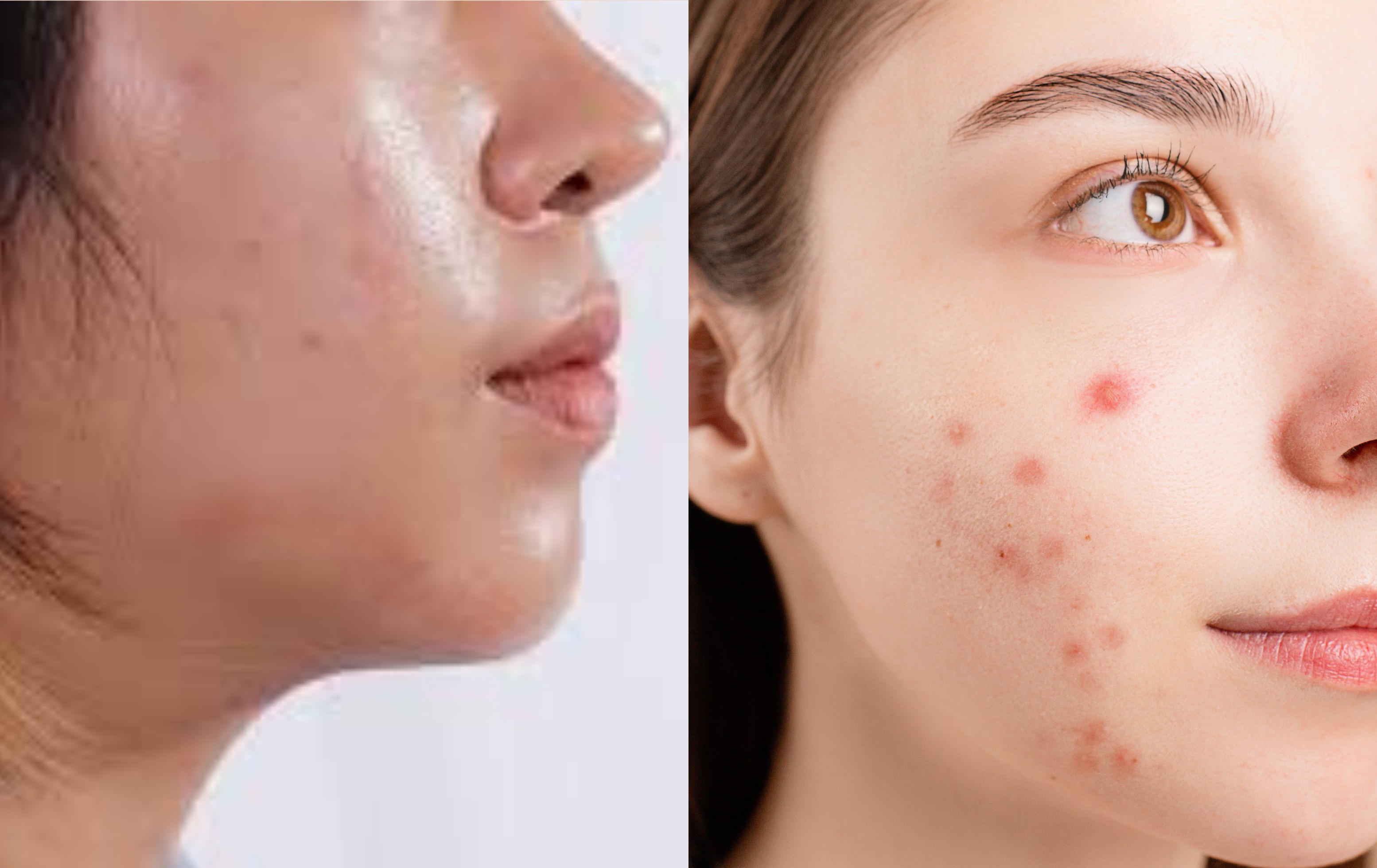 Is oily skin and acne-prone skin the same