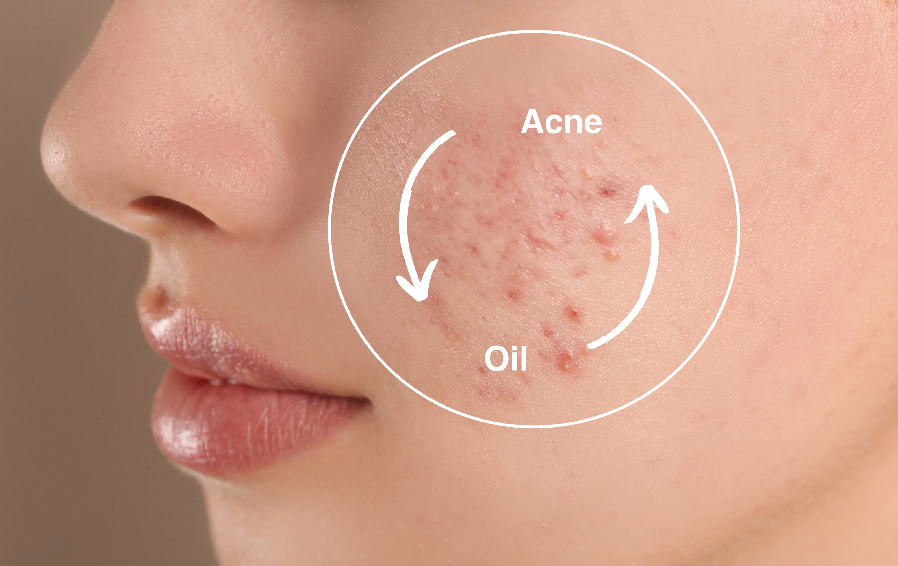 Relationship Between Oily Skin and Acne