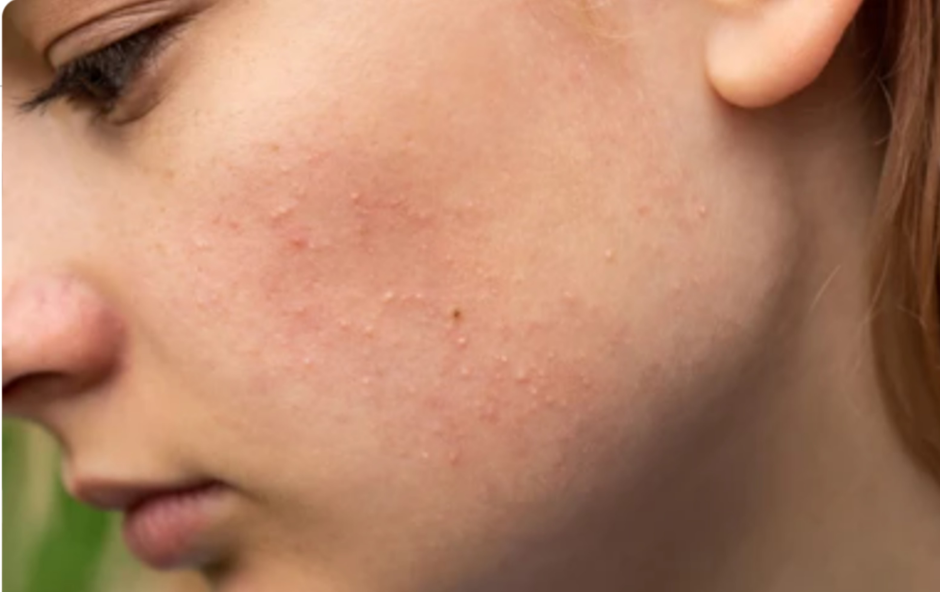 what is fungal acne