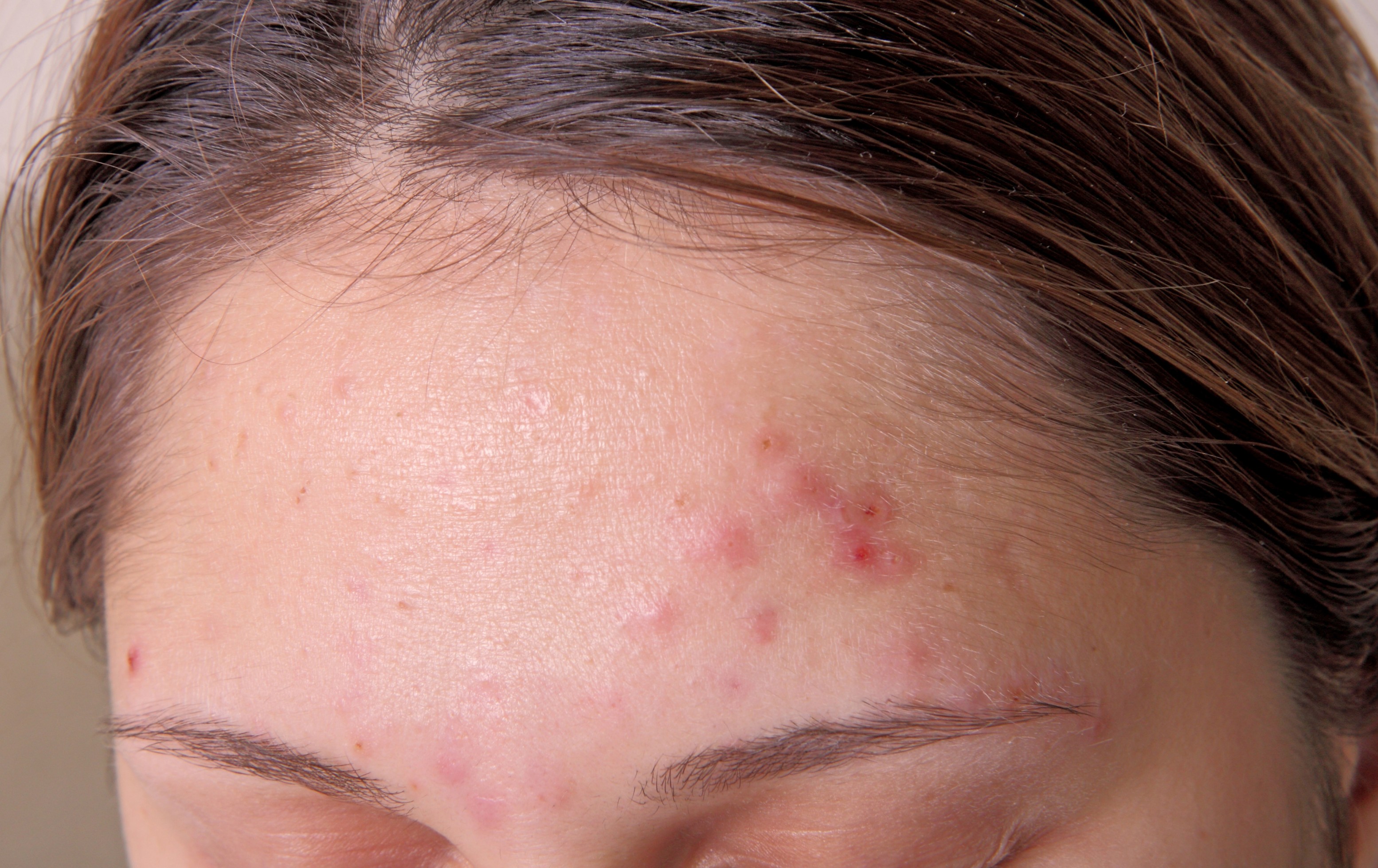 acne due to dandruff