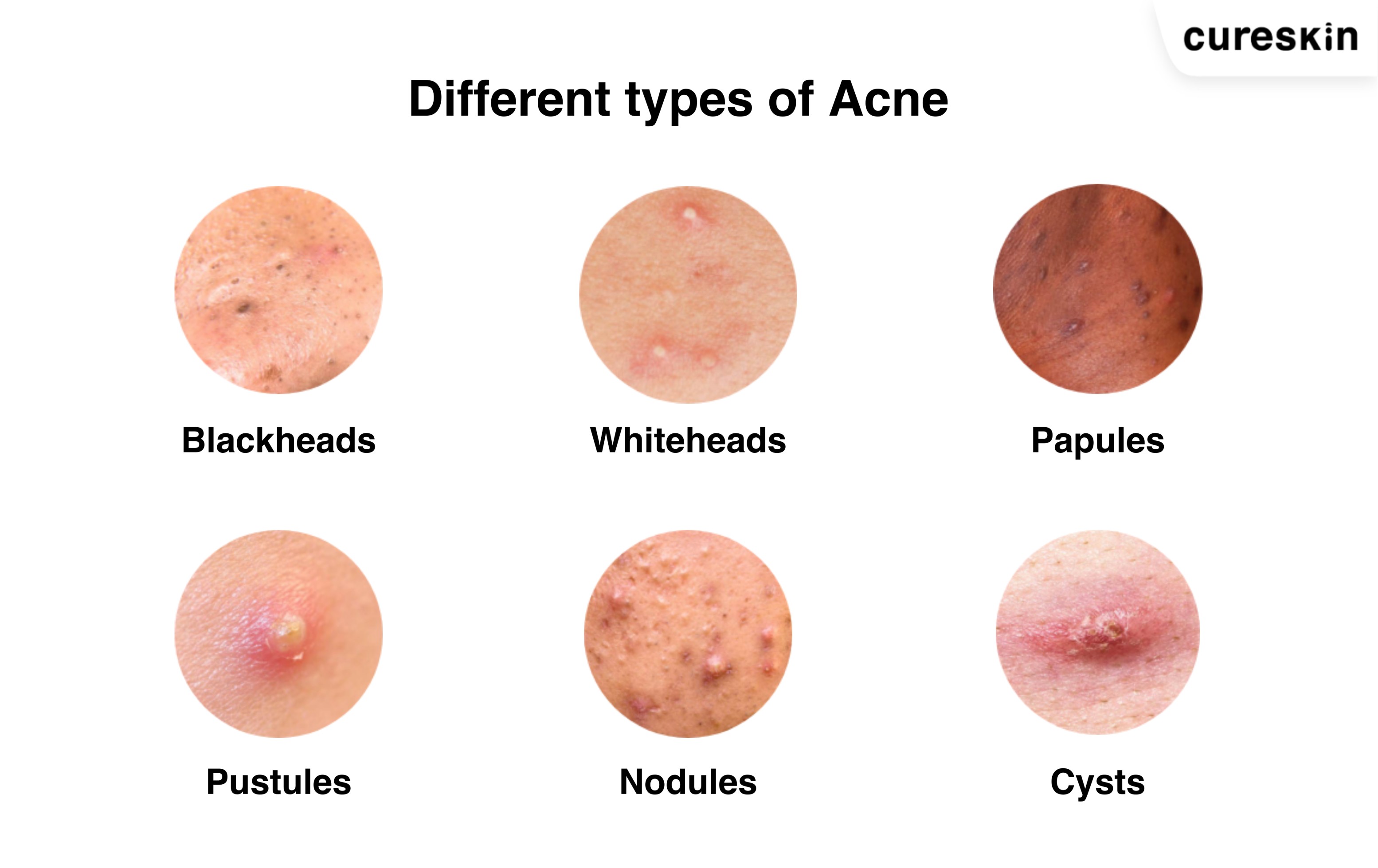 Mistakes People Make During Acne Treatment - Cureskin